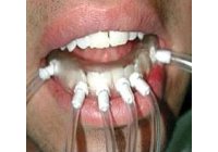 Innovaci�n sanitaria con OZONO