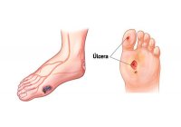 PIE DIABETICO tratamiento con OZONO